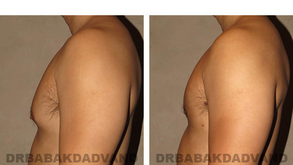 Gynecomastia. Before and After Treatment Photos - male, left side view (patient 36)