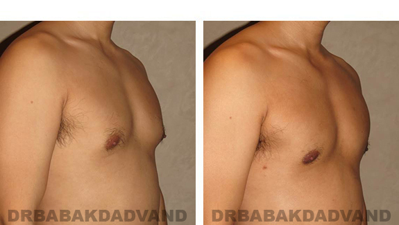 Gynecomastia. Before and After Treatment Photos - male, right side oblique view (patient 36)