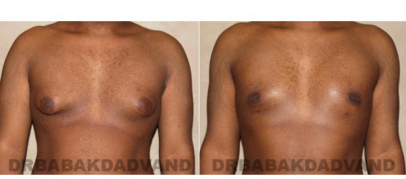 Gynecomastia. Before and After Treatment Photos - male, front view (patient 2)