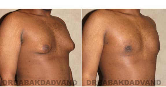 Gynecomastia. Before and After Treatment Photos - male, right side oblique view (patient 2)