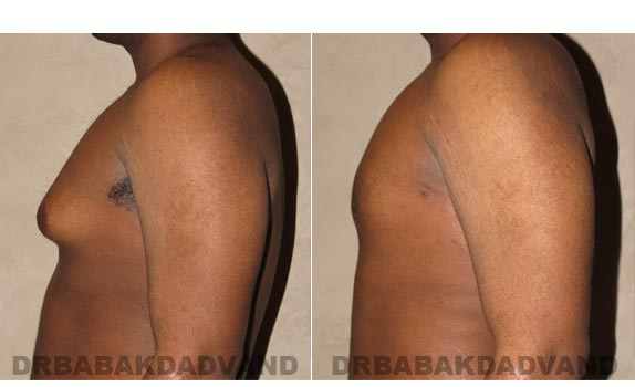 Gynecomastia. Before and After Treatment Photos - male, left side view (patient 2)