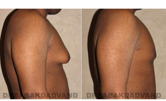 Gynecomastia. Before and After Treatment Photos - male, right side view (patient 2)