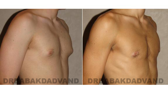 Gynecomastia. Before and After Treatment Photos - male - right side oblique view (patient - 9)