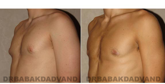 Gynecomastia. Before and After Treatment Photos - male - left side oblique view (patient 9)