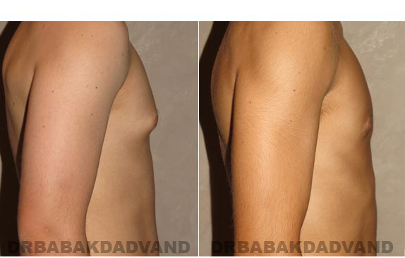 Gynecomastia. Before and After Treatment Photos - male - right side view (patient - 9)