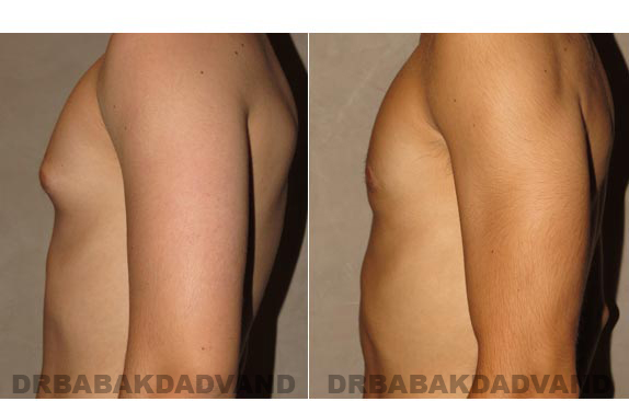 Gynecomastia. Before and After Treatment Photos - male - left side view (patient - 9)