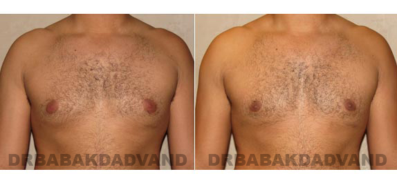 Gynecomastia. Before and After Treatment Photos - male, front view (patient 13)