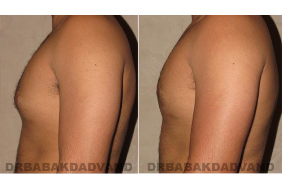 Gynecomastia. Before and After Treatment Photos - male, left side view (patient 13)