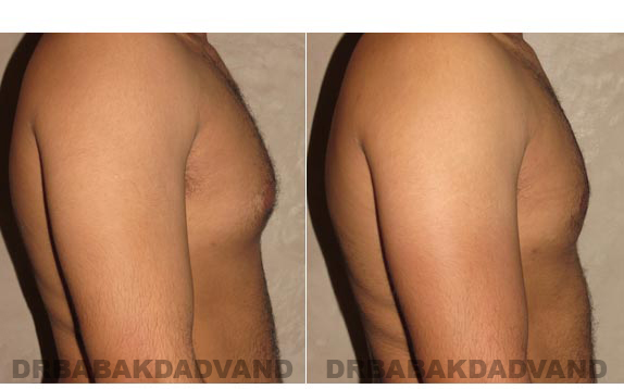 Gynecomastia. Before and After Treatment Photos - male, right side view (patient 13)