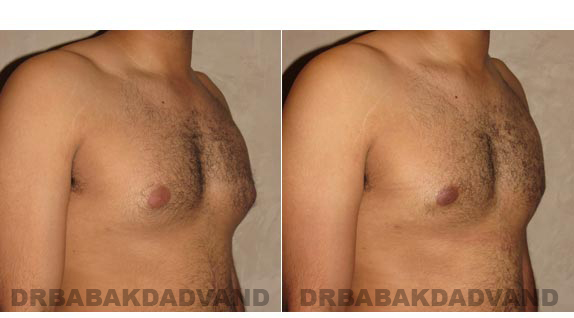 Gynecomastia. Before and After Treatment Photos - male, right side oblique view (patient 13)