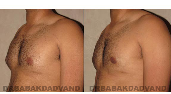 Gynecomastia. Before and After Treatment Photos - male, left side oblique view (patient 13)