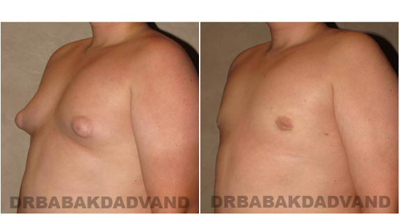 Gynecomastia. Before and After Treatment Photos - male - left side oblique view (patient 6)