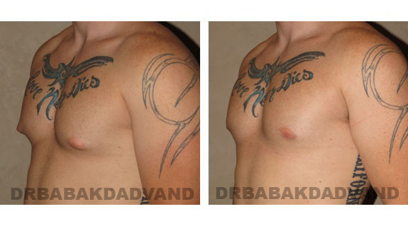 Gynecomastia. Before and After Treatment Photos - male, left side oblique view (patient 4)
