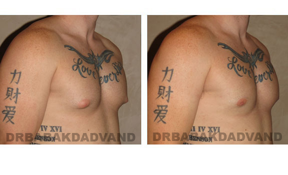 Gynecomastia. Before and After Treatment Photos - male, right side oblique view (patient 4)