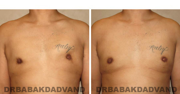 Before and After Treatment Photos - male, frontal view (patient 1)