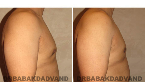 Before and After Treatment Photos - male, right side view (patient 1)