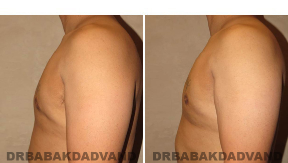 Before and After Treatment Photos - male, left side view (patient 1)