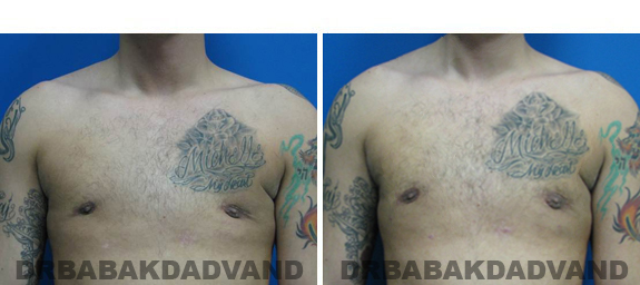 Before and After Treatment Photos - male, frontal view (patient 3)