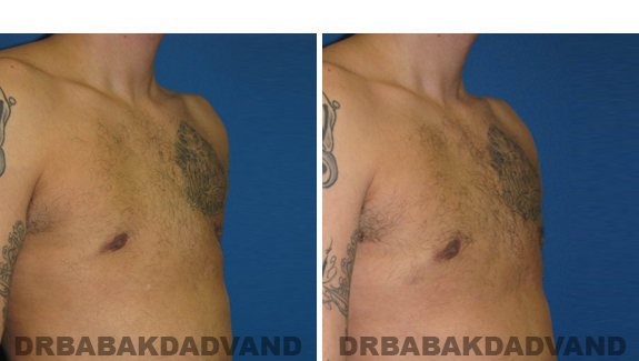 Before and After Treatment Photos - male, right side oblique view (patient 3)