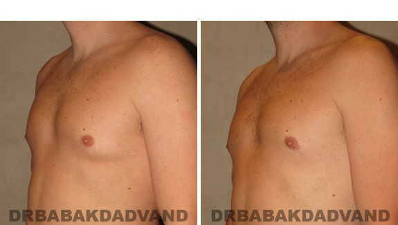 Before and After Treatment Photos - male, left side oblique view (patient 4)