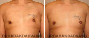 REVISION GYNECOMASTIA. Before and After Photos - Patient 1, 34 year old male