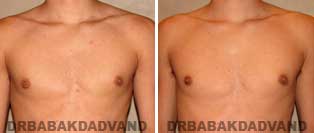 REVISION GYNECOMASTIA. Before and After Photos - Patient 2, 17 year old male