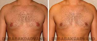 REVISION GYNECOMASTIA. Before and After Photos - Patient 5, 34 year old male
