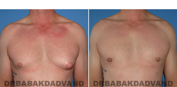 Gynecomastia. Before and After Treatment Photos  - male - front view (patient 46)
