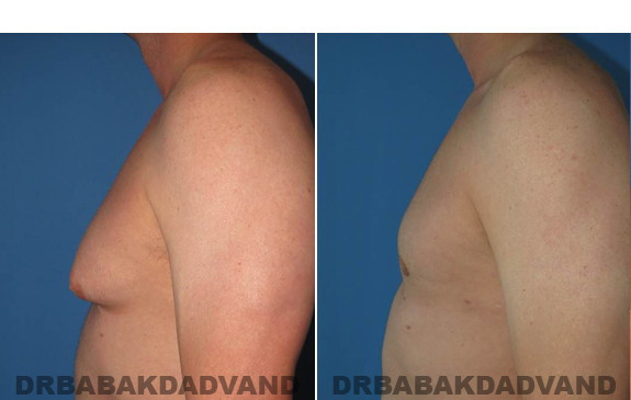 Gynecomastia. Before and After Treatment Photos  - male - left side view (patient 46)