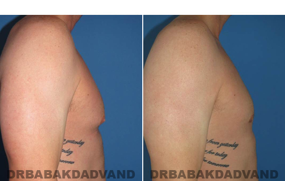 Gynecomastia. Before and After Treatment Photos  - male - right side view (patient 46)