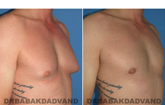 Gynecomastia. Before and After Treatment Photos  - male - right side oblique view (patient 46)