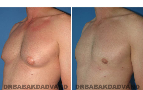 Gynecomastia. Before and After Treatment Photos  - male - left side oblique view (patient 46)