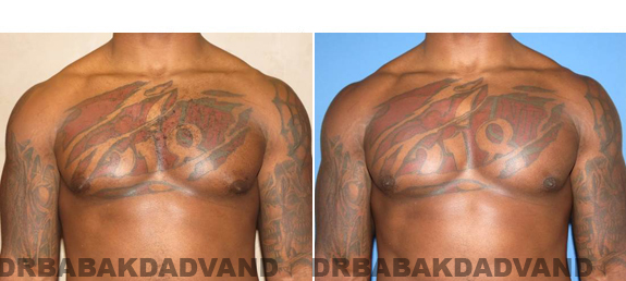 Gynecomastia. Before and After Treatment Photos  - male - front view (patient 47)