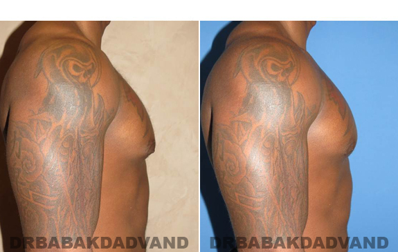 Gynecomastia. Before and After Treatment Photos  - male - right side view (patient 47)