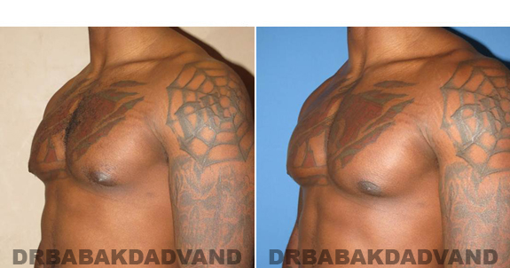 Gynecomastia. Before and After Treatment Photos  - male - left side oblique view (patient 47)
