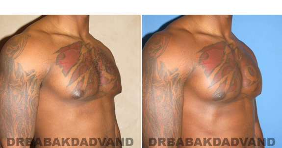 Gynecomastia. Before and After Treatment Photos  - male - right side oblique view (patient 47)