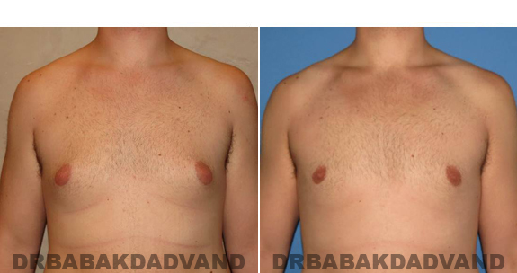 Gynecomastia. Before and After Treatment Photos - male, front view (patient 48)