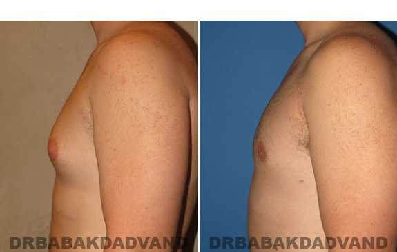Gynecomastia. Before and After Treatment Photos  - male - left side view (patient 48)