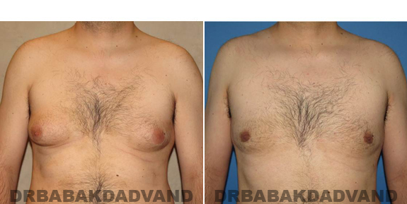 Gynecomastia. Before and After Treatment Photos - male - front view (patient - 50)