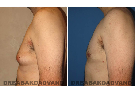 Gynecomastia. Before and After Treatment Photos - male - left side view (patient - 50)
