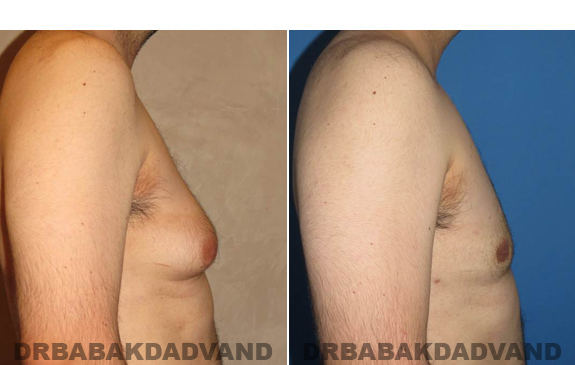 Gynecomastia. Before and After Treatment Photos - male - right side view (patient - 50)