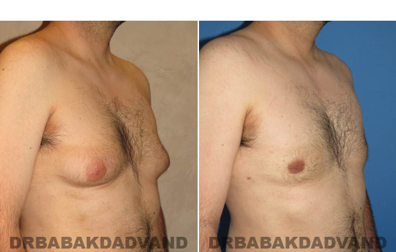 Gynecomastia. Before and After Treatment Photos - male - right side oblique view (patient - 50)
