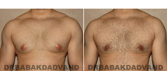 Gynecomastia. Before and After Treatment Photos - male - front view (patient - 51)