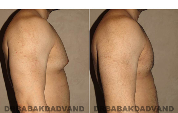 Gynecomastia. Before and After Treatment Photos - male - right side view (patient - 51)