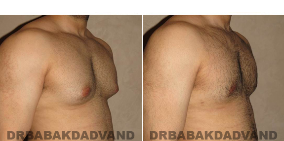 Gynecomastia. Before and After Treatment Photos - male - right side oblique view (patient - 51)