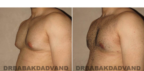 Gynecomastia. Before and After Treatment Photos - male - left side view (patient - 51)