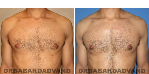 Gynecomastia. Before and After Treatment Photos - male - front view (patient - 52)