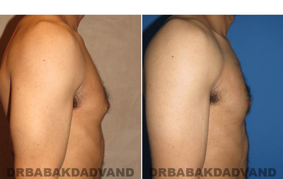 Gynecomastia. Before and After Treatment Photos - male - right side view (patient - 52)