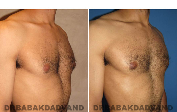 Gynecomastia. Before and After Treatment Photos - male - right side oblique view (patient - 52)