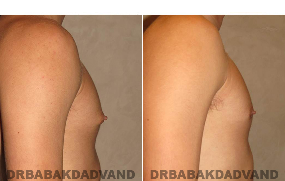 Gynecomastia. Before and After Treatment Photos - male - right side view (patient - 53)